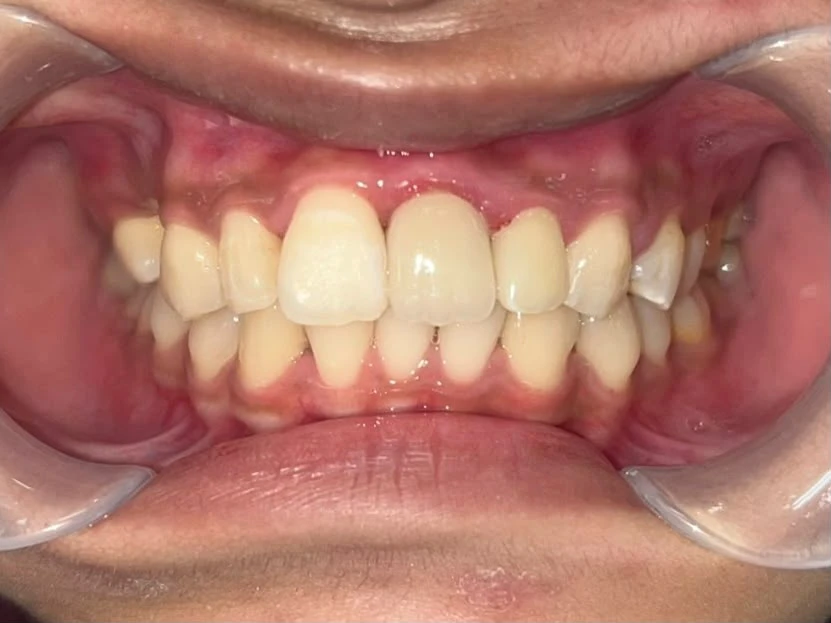 After photograph: zirconia crown restoration after root canal treatment.