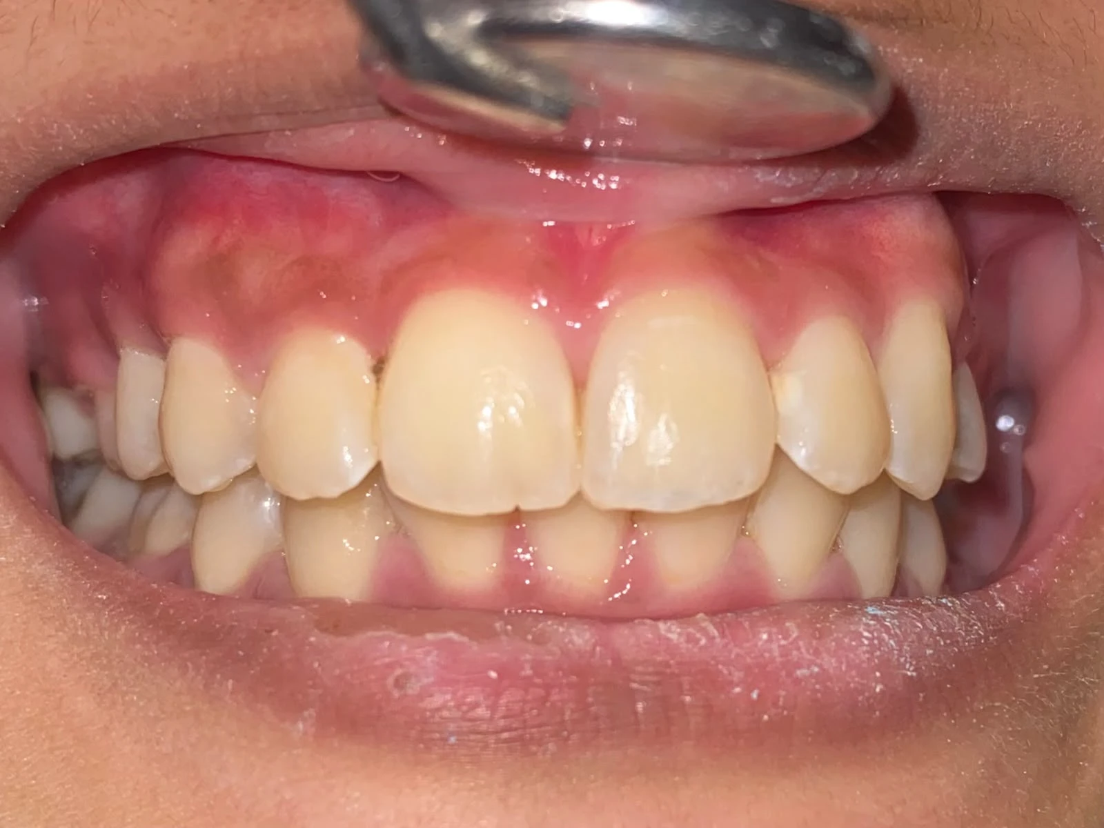After photograph: class III composite restoration on tooth 21.