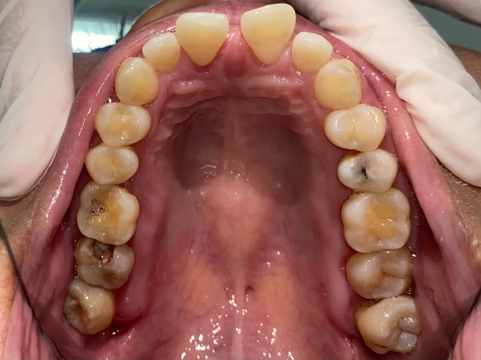 After photograph: scaling and root planing.