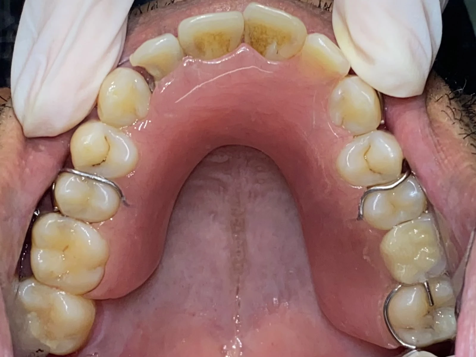 After photograph: removable acrylic partial denture.