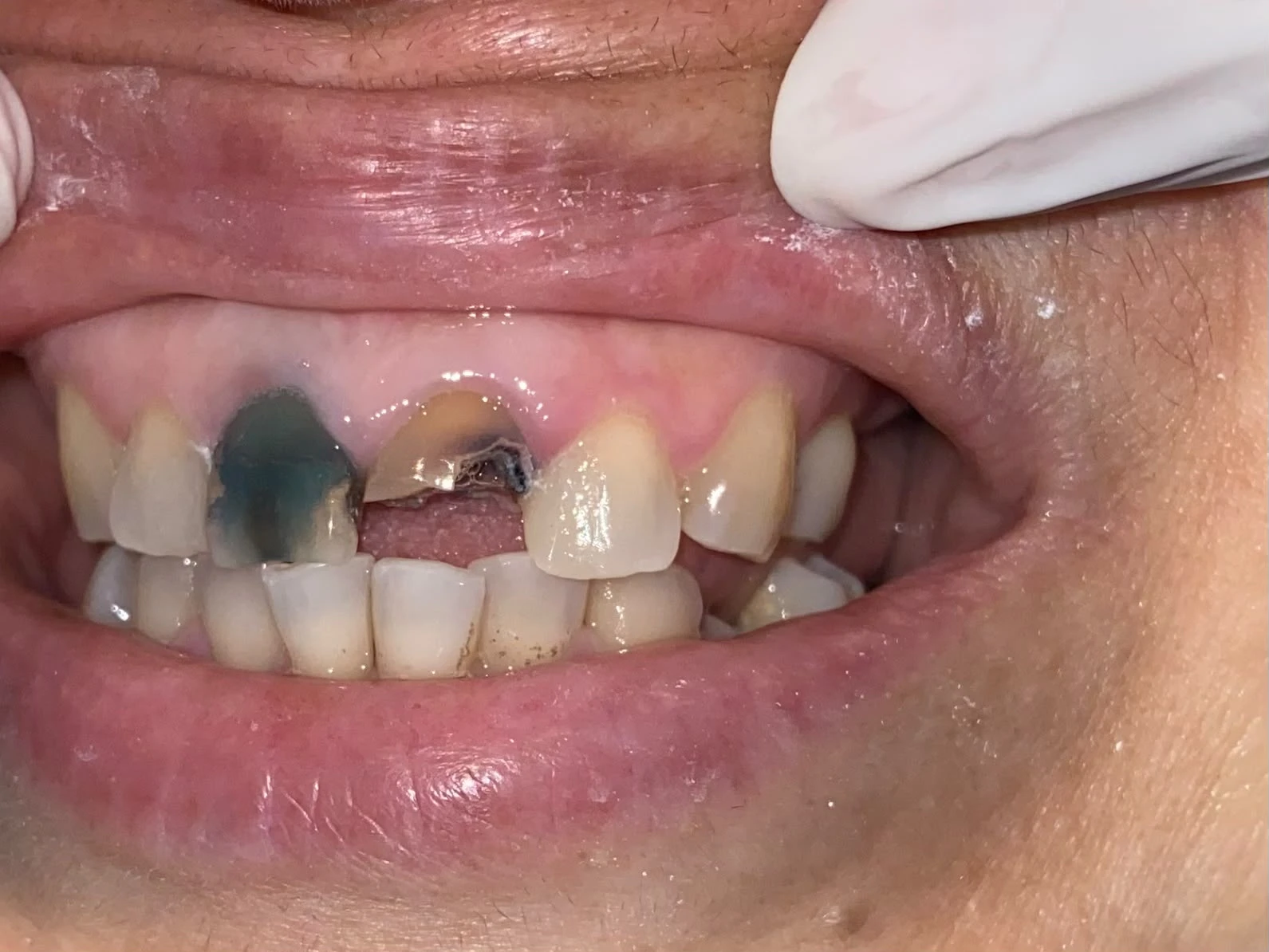 After photograph: class IV composite restoration of tooth 22.