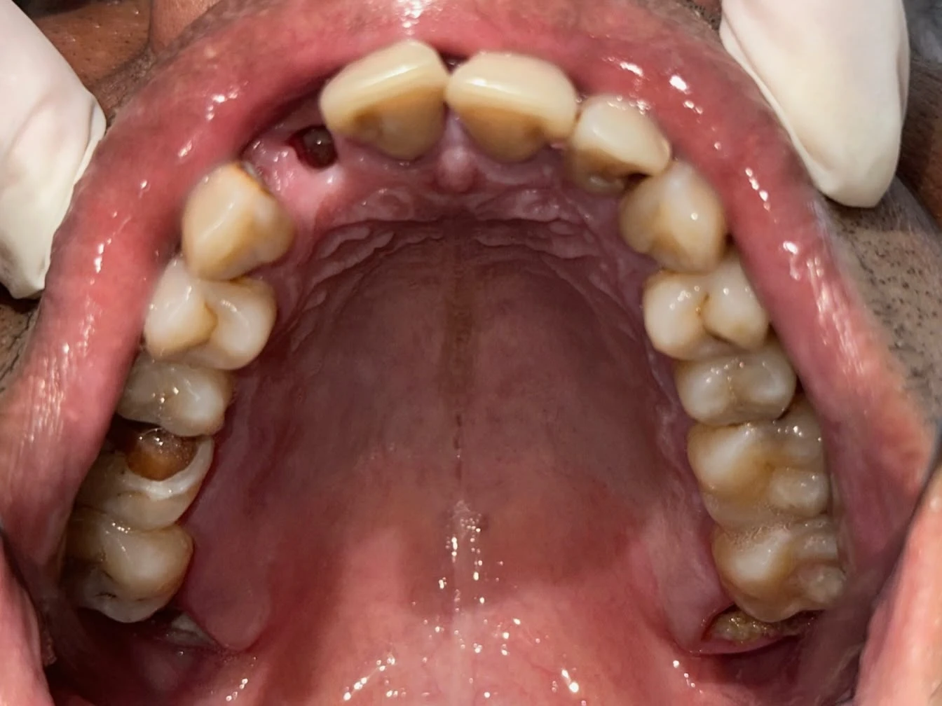 Before photograph: removable acrylic partial denture.