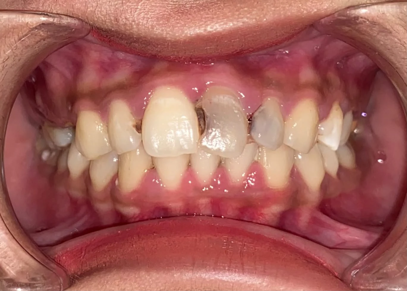 Before photograph: zirconia crown restoration after root canal treatment.