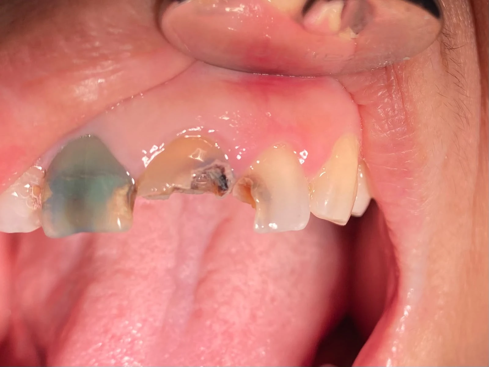 Before photograph: class IV composite restoration of tooth 22.