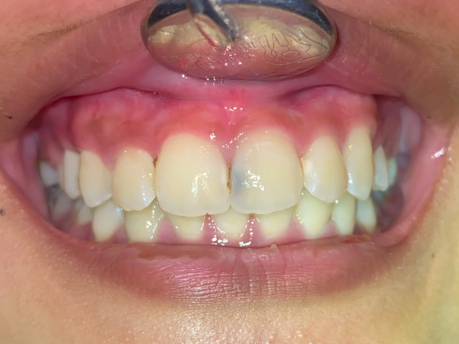 Before photograph: class III composite restoration on tooth 21.